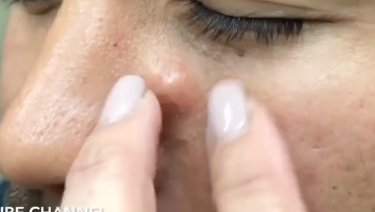 Dr. Pimple Popper — The ‘Fish and Hook’ Method, You Have To See This!!