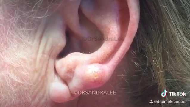 Dr. Pimple Popper — See This Giant Earlobe Cyst Explode Like Popping Popcorn!