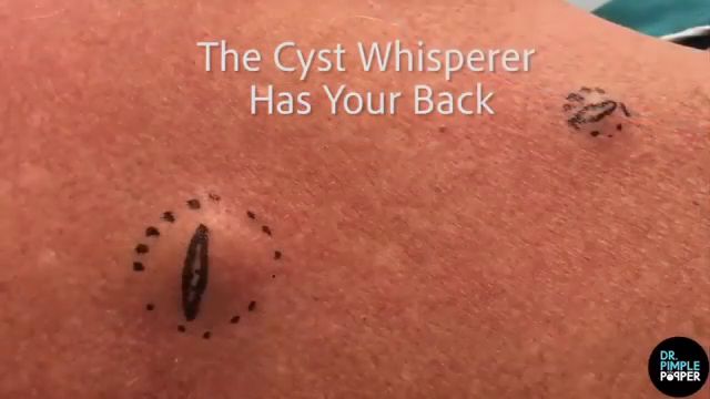 Dr. Pimple Popper — Watch The ‘Cyst Whisperer’ Take On This Monster Back Lump!