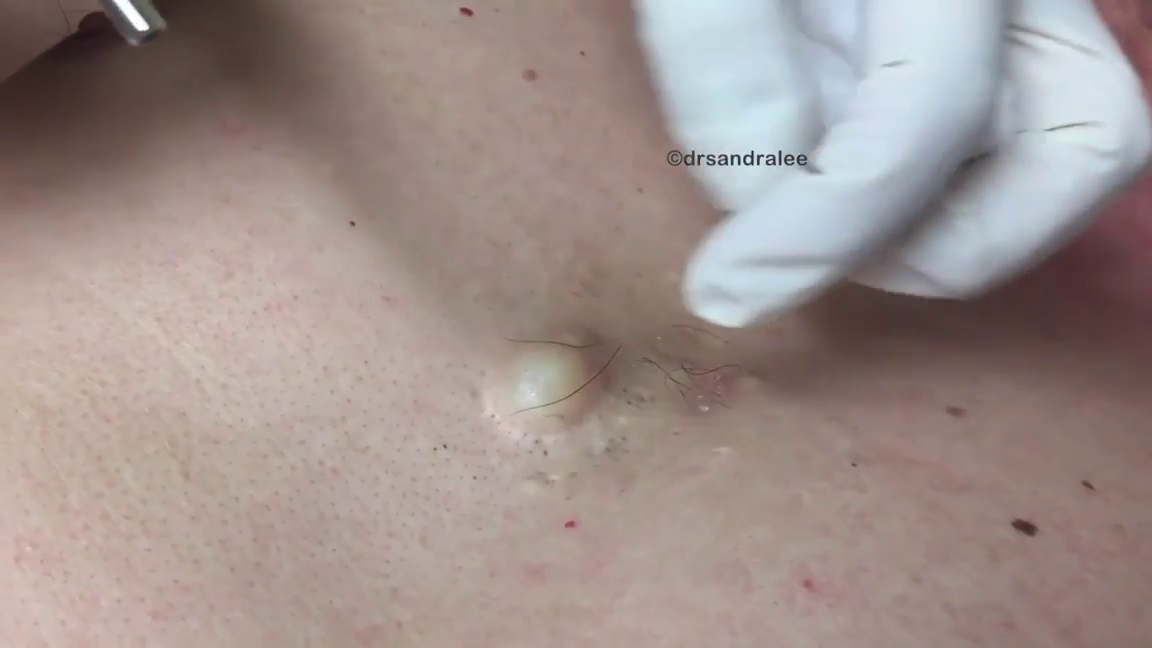Dr. Pimple Popper — Huge Cyst Leave This Patient With GIANT Hole In His Chest!