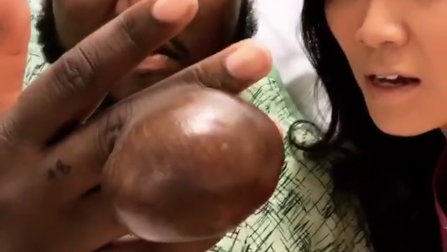 Dr. Pimple Popper — Watch This Huge ‘Racquetball’ Sized Growth Get Sliced Off Of Patient