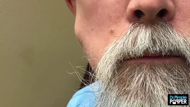 Dr. Pimple Popper — Watch This ‘Cheeky’ Cyst EXPLODE Out Of Patient Face!!