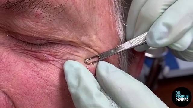 Blackheads  Dr Pimple Popper 