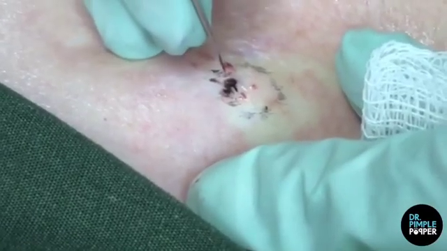 Dr. Pimple Popper — See The Shocking ‘Loaded Cauliflower’ Blackhead Get Popped!