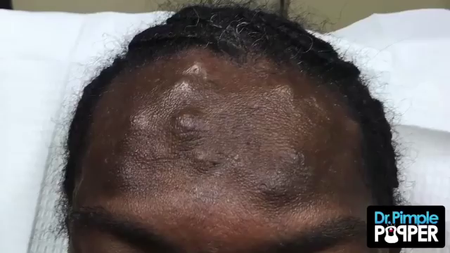 Dr. Pimple Popper — Mass Amount Of Cysts Looks Like ‘Skittles’ Popping Out Of This  Forehead