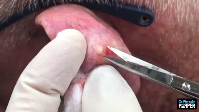 Dr. Pimple Popper — This Huge Whitehead Is What Happens If You Don’t Clean Behind Your Ears!