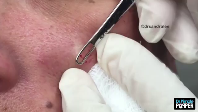 Dr. Pimple Popper — See This Whitehead Make A HUGE Splash On This Guy’s Face!