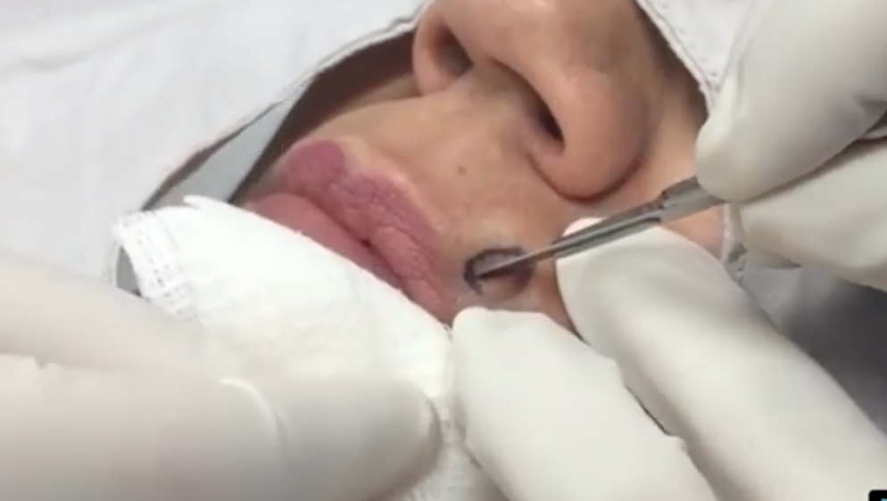 Dr. Pimple Popper — Watch A Huge One Pop Across The Room In SLOW MOTION!