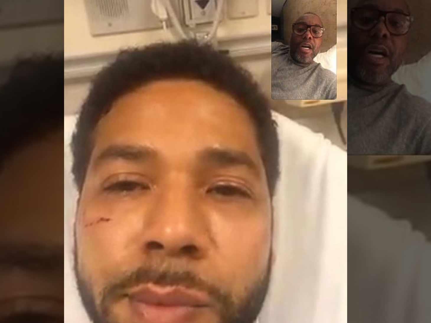 Jussie Smollett Seen with Facial Injuries in First Time Since Vicious Attack