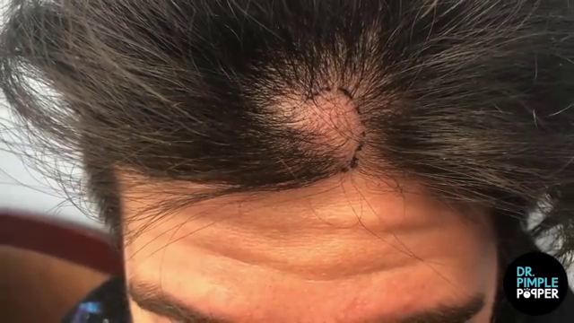 Dr. Pimple Popper — This Looks Like A Whole “Clove Of Garlic” Comes Out Of His Head