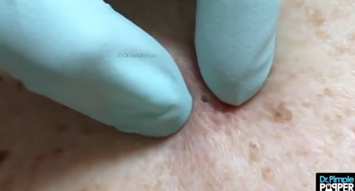 Dr. Pimple Popper — Blackheads Are Sometimes Bigger Than They Appear!
