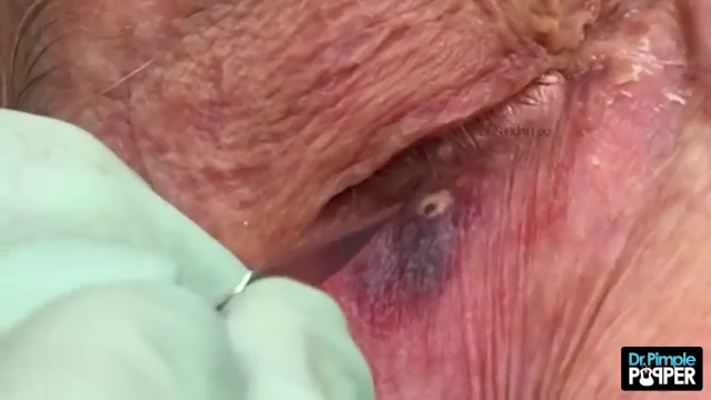 Dr. Pimple Popper — See The BIGGEST Blackhead Ever Sitting On An Eyeball!!