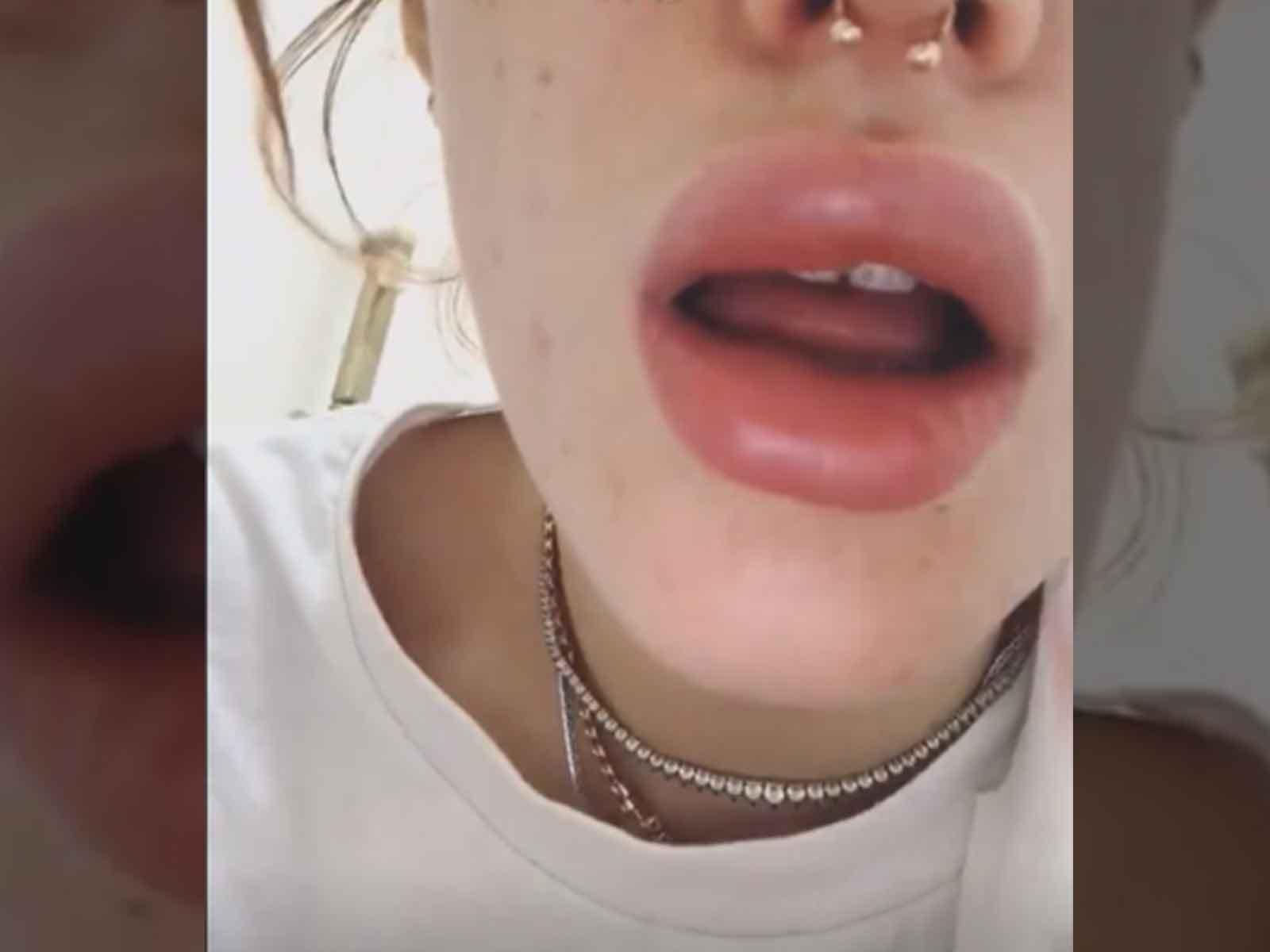 Bella Thorne Accused of Lip Injections After Suffering Allergic